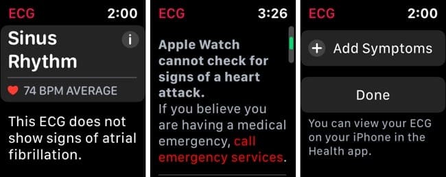 Apple Watch ECG Reading